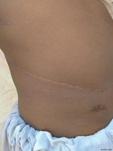 Muhammad Iqbal shows his scar (photo: DW/R. Aslam)